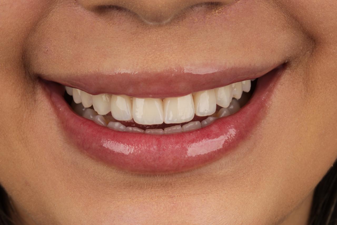 Depois — sorriso finalizado