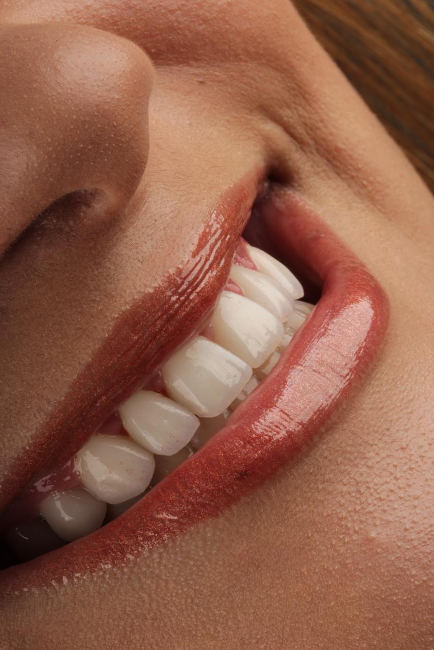 Depois — detalhe lateral